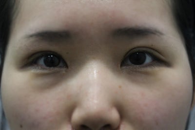 강남역눈재수술 고민된다면? '이것'부터 확인하세요 사진 3