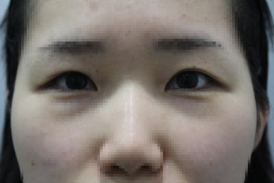 강남역눈재수술 고민된다면? '이것'부터 확인하세요 사진 2