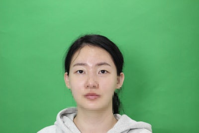 압구정눈매교정 받고 후회하지 않으려면 '이 부분'은 꼭 보세요 사진 4