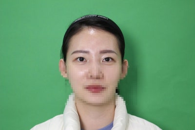 압구정눈매교정 받고 후회하지 않으려면 '이 부분'은 꼭 보세요 사진 5
