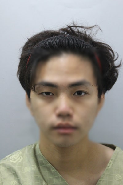 압구정쌍꺼풀 수술 실패 예방하고 싶다면 필독 사진 5