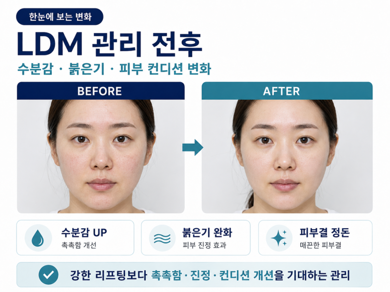 강남 LDM 물방울 리프팅, 이렇게 받아야 효과 있어요 사진 7