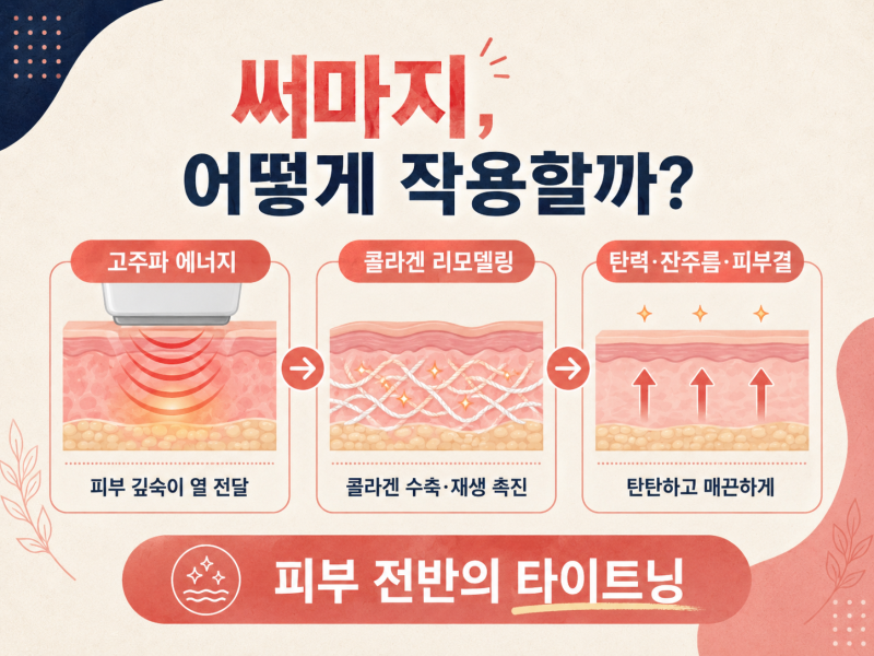 강남써마지와 울쎄라, 노화가 느껴질 때 선택은? 사진 5